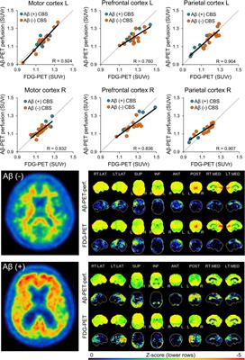 Dual-Phase β-Amyloid PET Captures Neuronal Injury and Amyloidosis in Corticobasal Syndrome